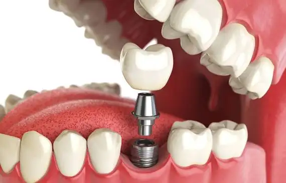 Dental Implants Watauga