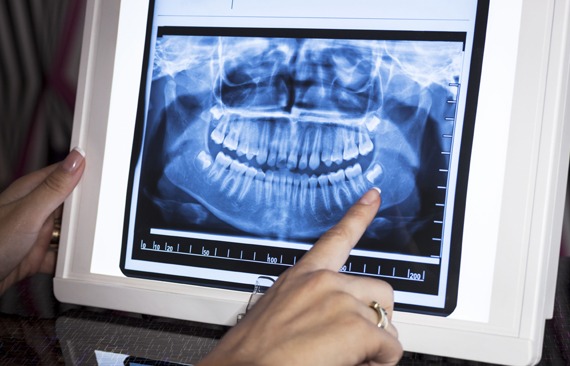 Dental-X-rays-Watauga