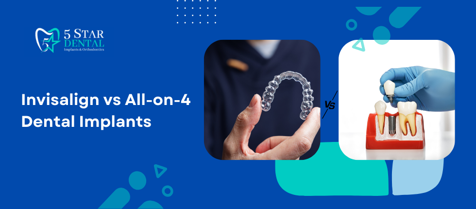Invisalign vs All-on-4 Dental Implants