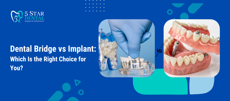 Dental Bridge vs Implant Which Is the Right Choice for You